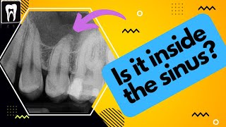 Is the root inside the maxillary sinus or not | Maxillary Sinus and Upper Molars relation |