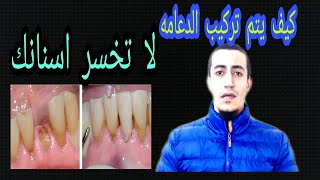 دعامه الاسنان بديل خلع جذور السن والضرس .علاج الاسنان المكسورة والجذور