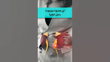 حصوات الكلية أو الحالب بدقيقة واحدة 