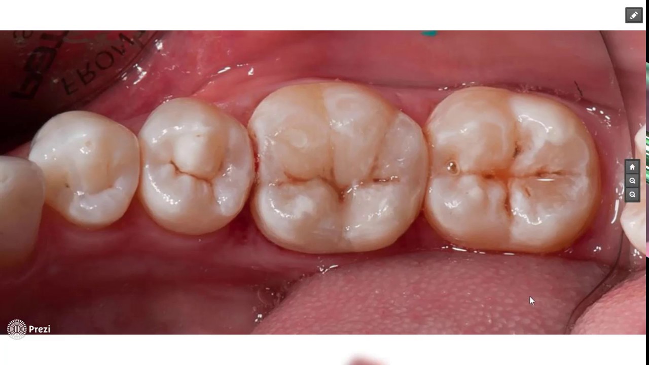 Dental Composite Part {4/4}