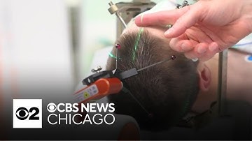 Boy becomes first person fitted with brain implant to control epileptic seizures