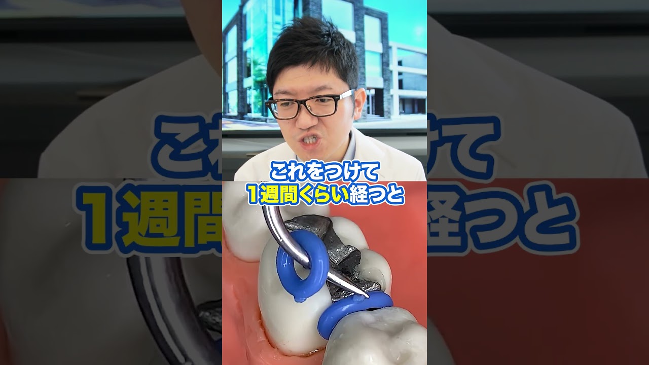 歯と歯の間に隙間ができる！？歯間分離を先生が解説！#shorts