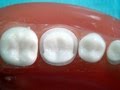 Metal ceramic crown preparation " for dental students "