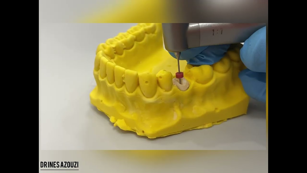 Les reconstitutions corono-radiculaires coulées