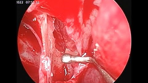 ESPAL : Endoscopic Sphenopalatine Artery Ligation / Cautery