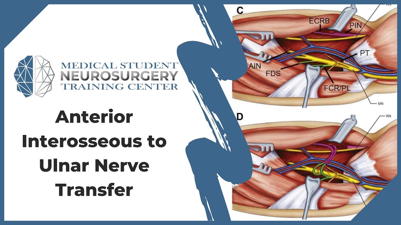 Anterior Interosseous To Ulnar Nerve Transfer Youtube