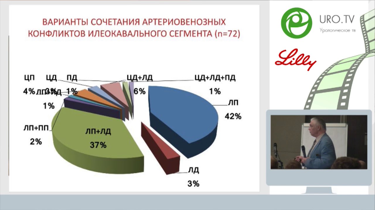 Капто А.А. Эндоваскулярная хирургия подвздошных вен при варикозной ...