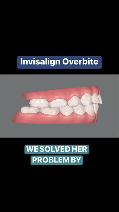 How we corrected this patient’s overbite.