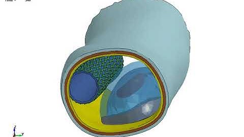 LS-DYNA Examples - Coronary Artery Stenting
