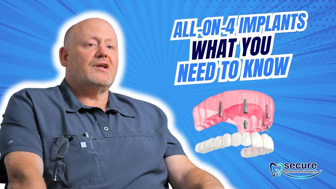 All-On-4 Dental Implants, What You Need to Know in Springfield, MO!