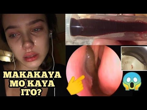 NANGANIB ANG BUHAY ng dalaga matapos matagpuan ang hayop na  ito sa loob ng kanyang ilong