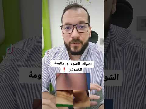 التصبغات الجلدية المصاحبة لمقاومة الانسولين مش بتختفي