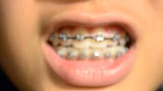 Braces Update #1! | Tori Diaz