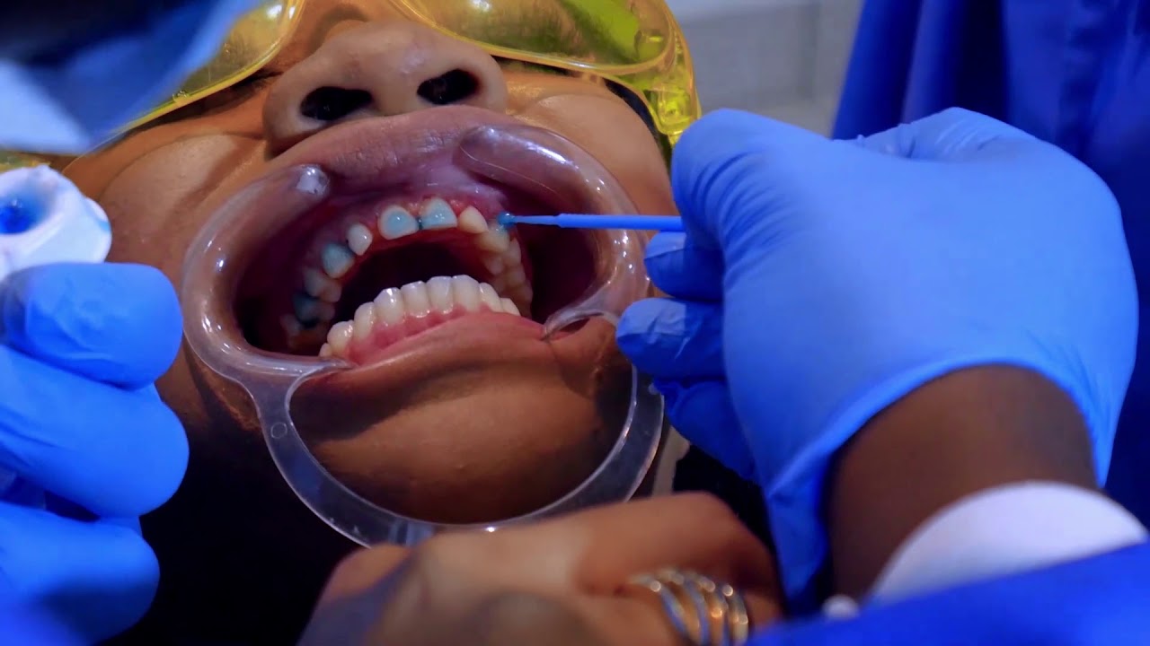 Veneers in Ghana 001 YouTube