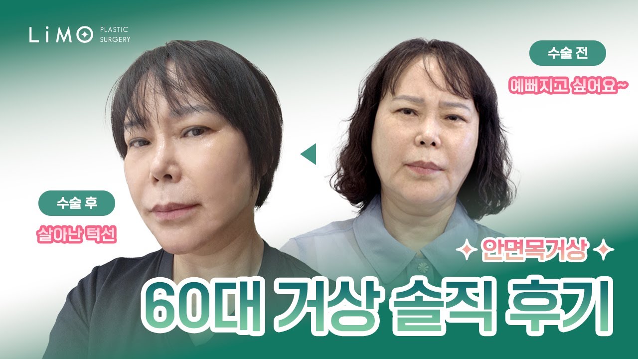 금실, 보톡스, 리프팅 화장품 다 해봤는데... 결국 '수술'로 돌아온 이유 (안면거상 재수술 솔직후기)