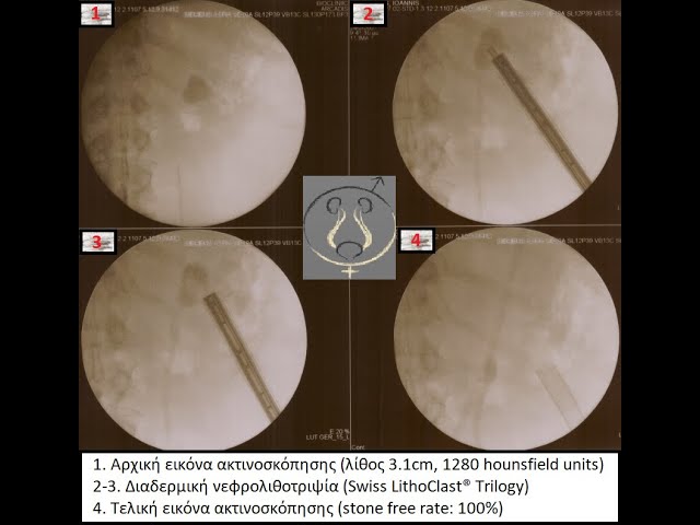 Διαδερμική νεφρολιθοτριψία με τη χρήση του νέου συστήματος λιθοτριψίας Swiss LithoClast® Trilogy