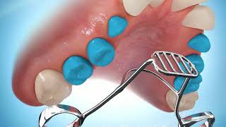 Tongue Habit Appliance