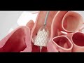 Das taviverfahren  behandlung einer aortenklappenstenose