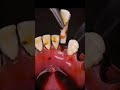 歯石レベル999 緊急治療する ASMR 歯石レベル999 緊急治療する ASMR