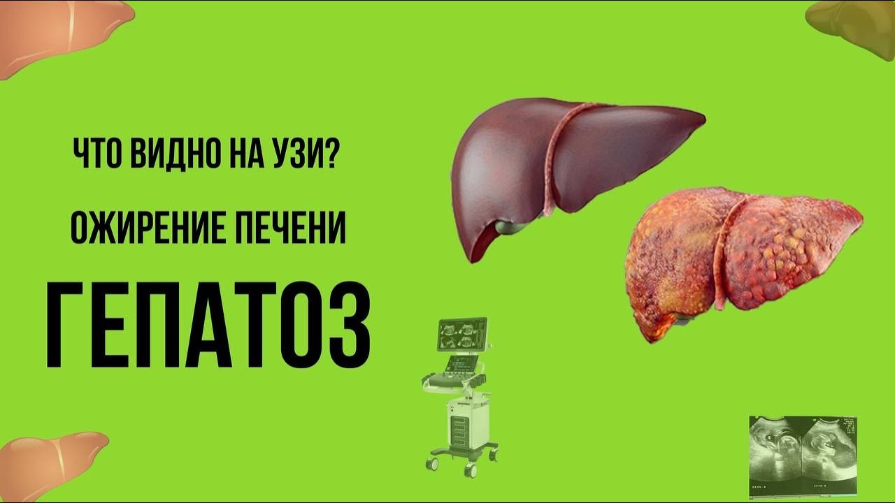Гепатоз или ожирение печени видно ли на УЗИ - YouTube