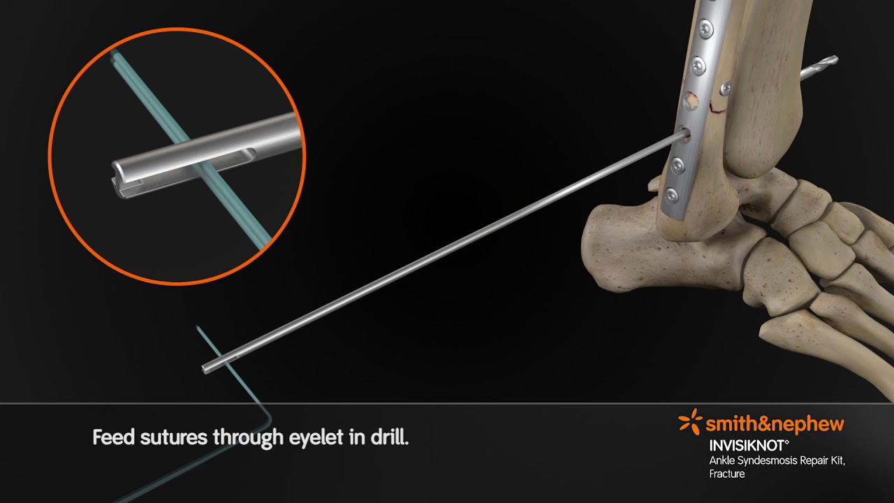 INVISIKNOT Syndesmosis Fracture 