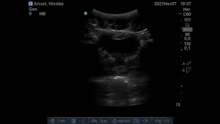 Fastevista Del Fondo De Saco De Douglas Masculino