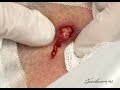 Owen Neck Boil (furuncle) Treat with Dr. Gonzo!