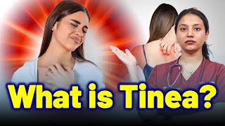 What Is Tinea Dermatophytosis, Ringworm ? Treatment Cure Relief Skin Hair Nail Homeopathy