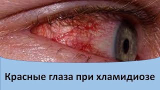 Красные глаза при хламидиозе