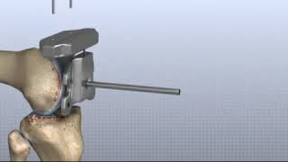 Knee Replacement Surgery - Know More about Knee Surgery at Medtravels