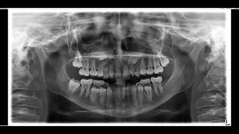 Impacted canines and congenitally missing wisdom teeth and #18 on panoramic radiograph