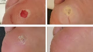 How to remove a wart with cider vinegar!