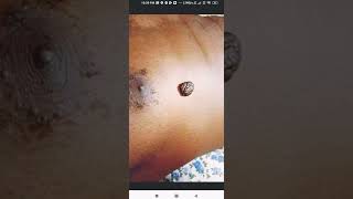 #genital warrs are contageous,fleshygrowth, in genital &amp; anal area #ayurvedacure #sextuallytransm
