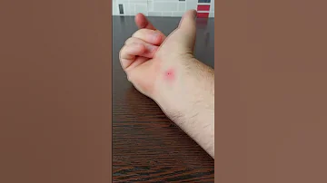 Как избавиться от укуса мадагаскарского таракана. Последствия укуса