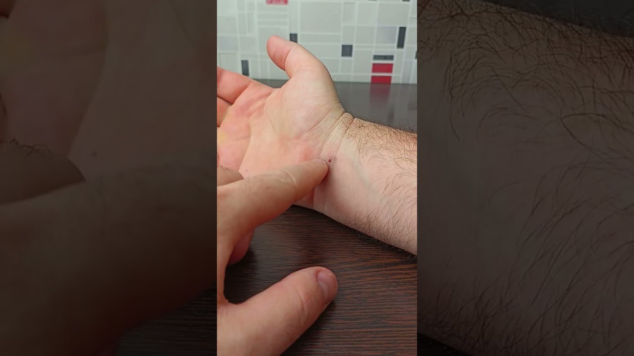 Как избавиться от укуса мадагаскарского таракана. Последствия укуса