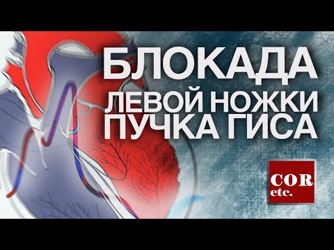 Как лечить блокаду левой ножки пучка гиса