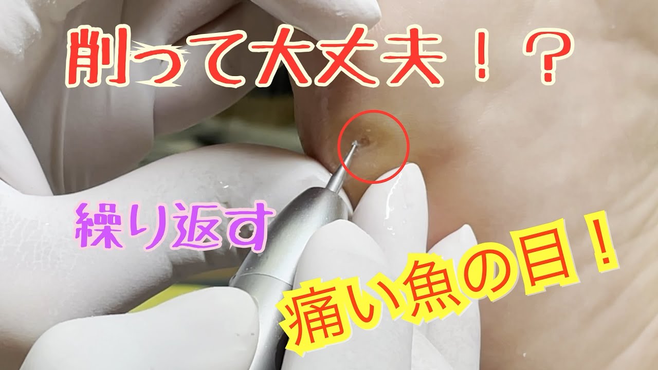 魚の目 痛みのない魚の目ケア ドクターネイル爪革命 横浜港北 Youtube