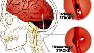 STROKE PATHOPHYSIOLOGY B.PHARM 2nd SEM