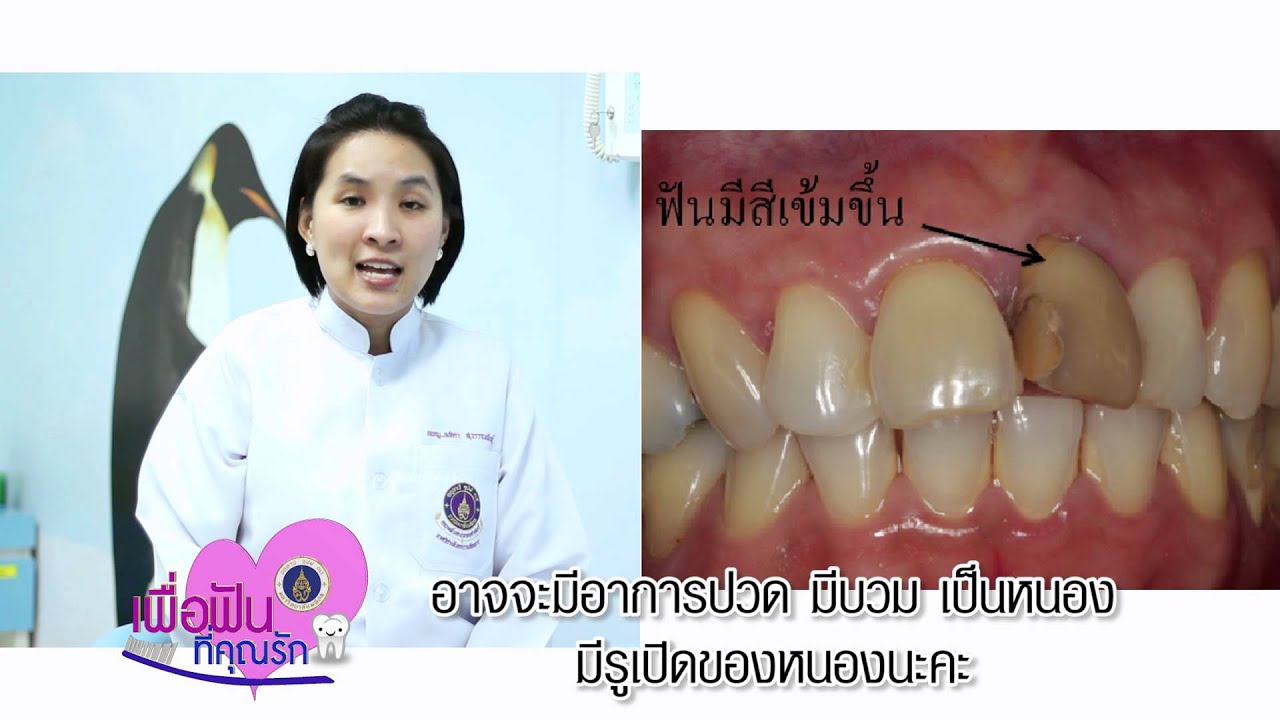 รายการเพื่อฟันที่คุณรัก ฟันตาย