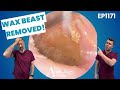 Deep Ear Wax Removal With Massive Skin Peel EP1171 Deep Ear Wax Removal With Massive Skin Peel EP1171