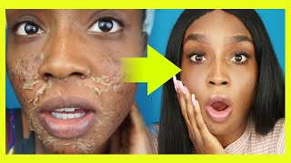 IS A CHEMICAL PEEL WORTH THE $$$ - VI Chemical Peel Update