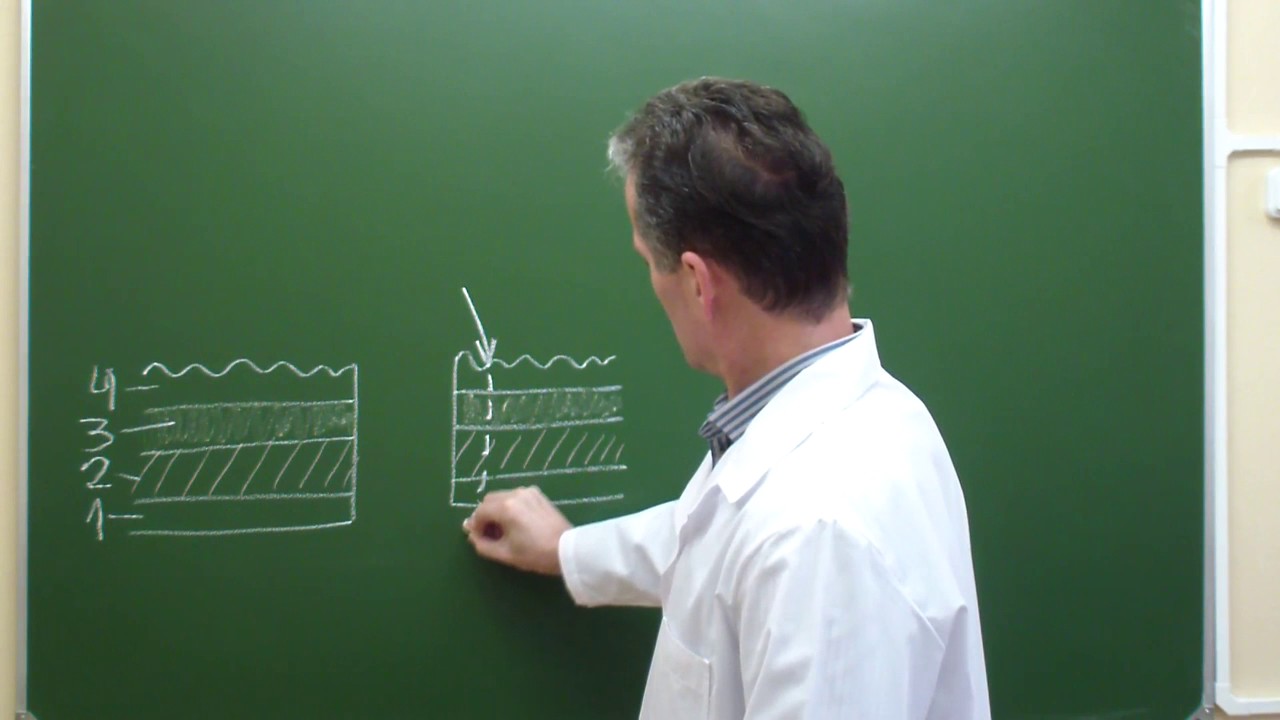 Схема непрерывного обвивного шва на заднюю губу межкишечного анастомоза