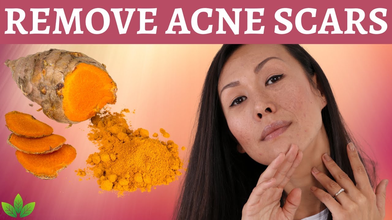 Remove Acne Scars with Turmeric YouTube