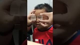 Pemeriksaan Mata Juling Strabismus