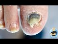 WHY IS HER BIG TOENAIL SO THICK & DARK?! ***HOW TO TREAT DAMAGED TOENAILS***