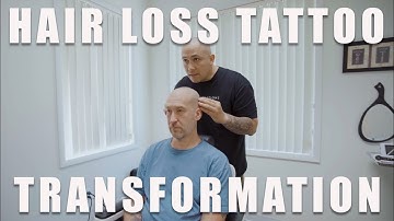 Hair Loss Tattoo Transformation (Scalp Micropigmentation)