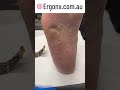 Satisfying Corn Removal from Carpenter's Foot #FootCare #Satisfying