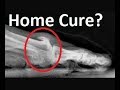 Big Toe Joint Arthritis Cure Without Surgery?  **Doctor Review**