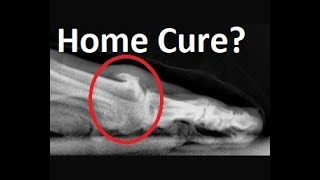 Big Toe Joint Arthritis Cure Without Surgery? Doctor Review