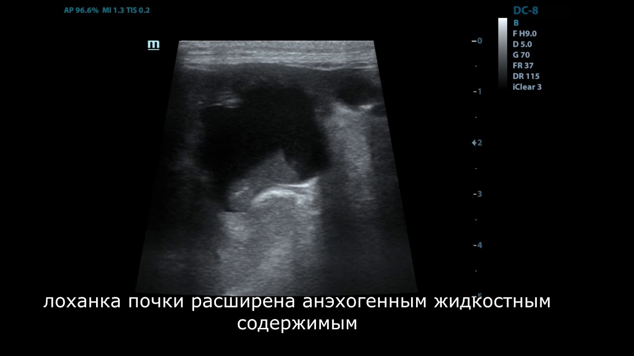 обструкция мочеточника
